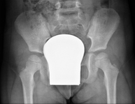 RX Caderas pediatría