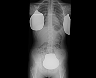 Telerradiología columna