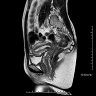 RM Pelvis femenina