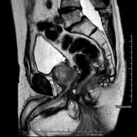 RM Pelvis masculina