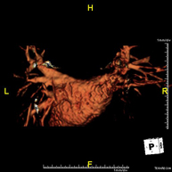 Angio RM Venas pulmonares