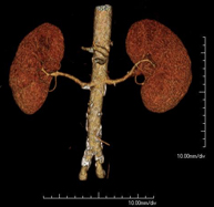 Angio-TC arterias renales_1