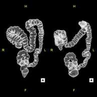 Colonoscopia virtual_1
