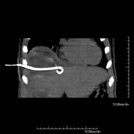 Drenaje abdominal guiado por TC
