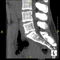 TC Columna lumbar