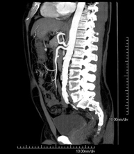 Angio-TC aorto-ilíaco