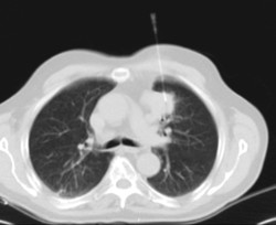 PAAF (Punción) Tórax guiada por TC