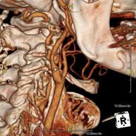 Angio – TC Troncos Supraaórticos