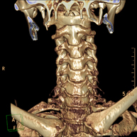 TC Columna cervical