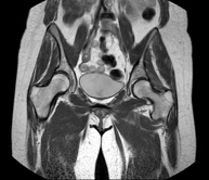 RM Caderas