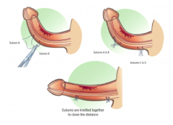 tratamiento quirurgico peyronie