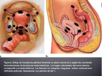 ecografía endometriosis
