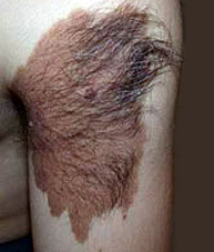 nevos melanocíticos congénitos
