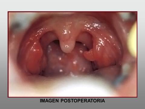 hipertrofia-image002