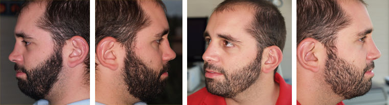 Rinoplastia2-Dra-Mir