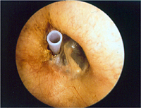 drenajes transtimpánicos