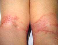 Dermatitis-atópica