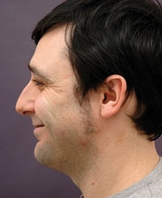 Cirurgia_estetica_testimoni_home_abans