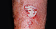 Aplicación de la crema en el carcinoma