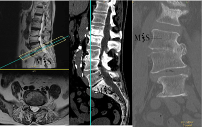 preop-osteophyte