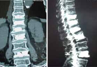 Cifoplastia_08