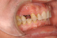 Implantes
