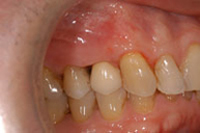 Implantes