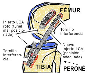 Revisión LCA