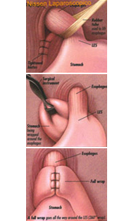 Hernia de hiato