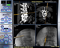 Fijación vertebral guiada con navegación_2