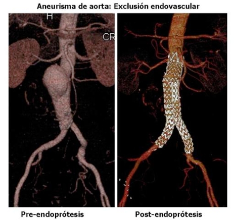 cirugia endovascular