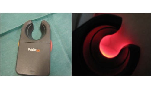 tratamiento varices y aranas vasculares