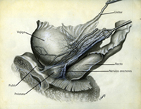 Prostatectomía radical_2