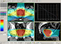 radioterapia_externa