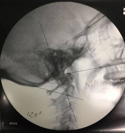 Occipitocervical fusion