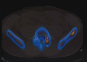 SPECT-Espondilolisis