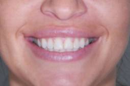 carillas de porcelana sonrisa antes