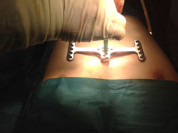 Imagen-de-la-operación-Pectus-Excavatum