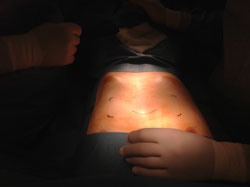 Segunda-imagen-de-la-operación-Pectus-Excavatum
