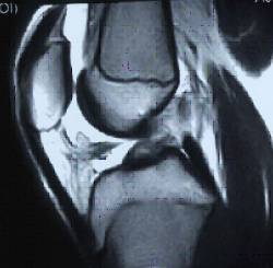 Lesiones ligamentosas