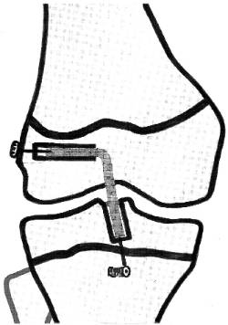 Lesiones ligamentosas