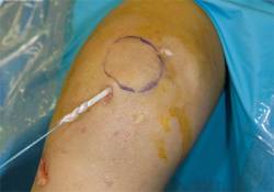 Inestabilidad fémoro patelar