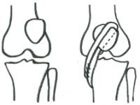 Inestabilidad fémoro patelar