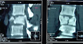 Fractura de vértebra lumbar