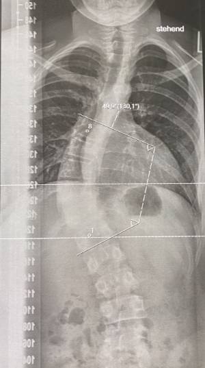 curva escoliotica con el ángulo de Cobb