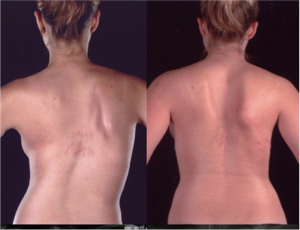 columna operada de escoliosis