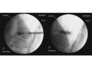 Ejemplo caso clínico cifoplastia 3