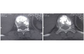 Ejemplo caso clínico cifoplastia 4