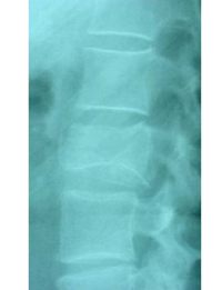 pre- y post-operatoria de una cifopastia cementada