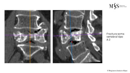 Caso clínico con estabilización percutánea de fractura vertebral inestable